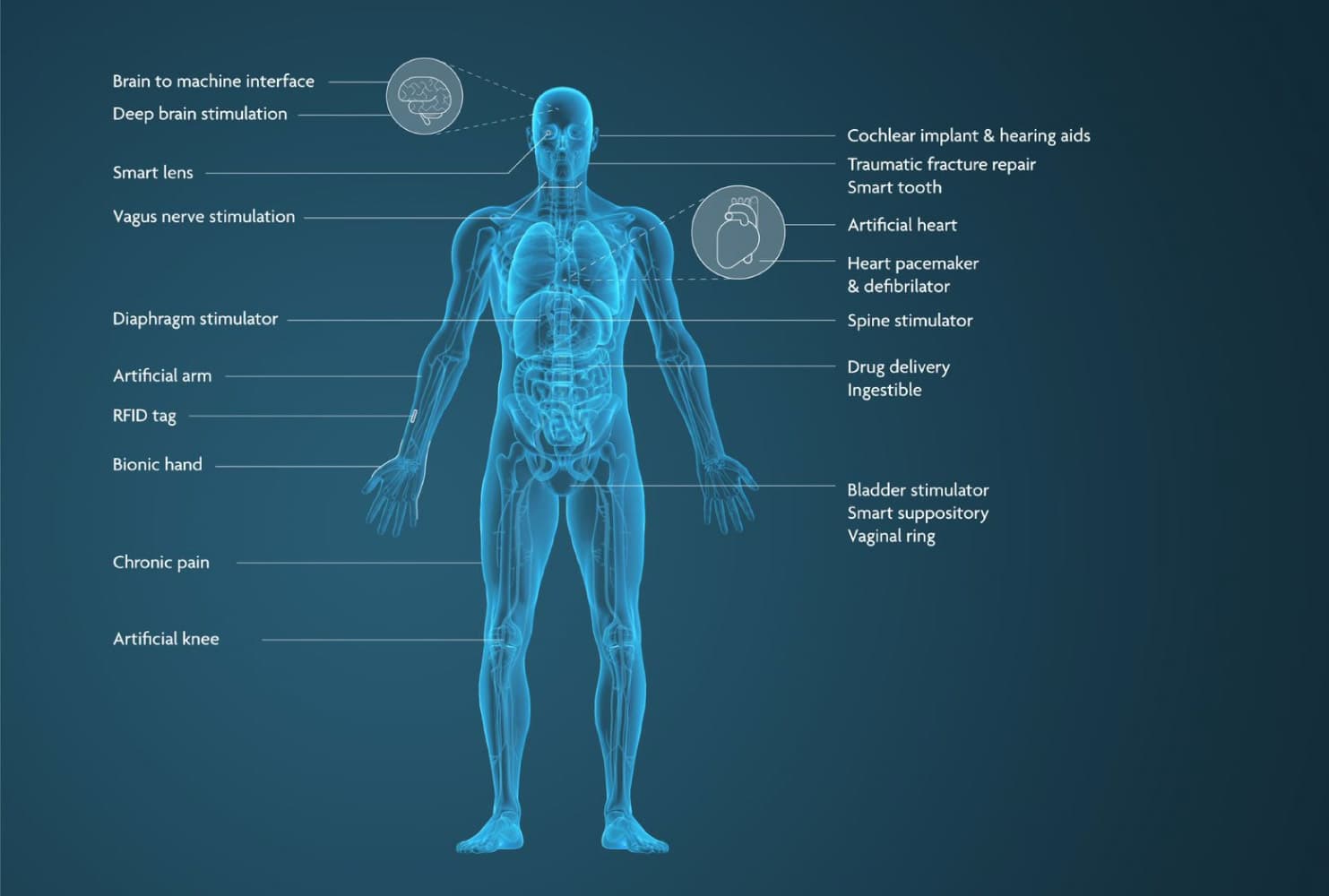 Mogelijke toepassingen voor medische implantaten. 